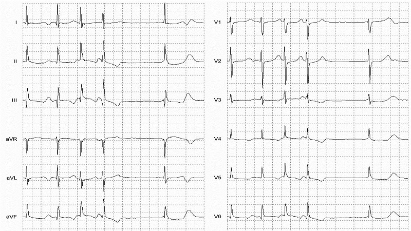 Atrial Paced Beat 12 Lead EKG